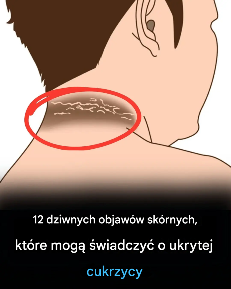 12 Dziwnych Problemów Skórnych Z Cukrzycą, Które Musisz Znać