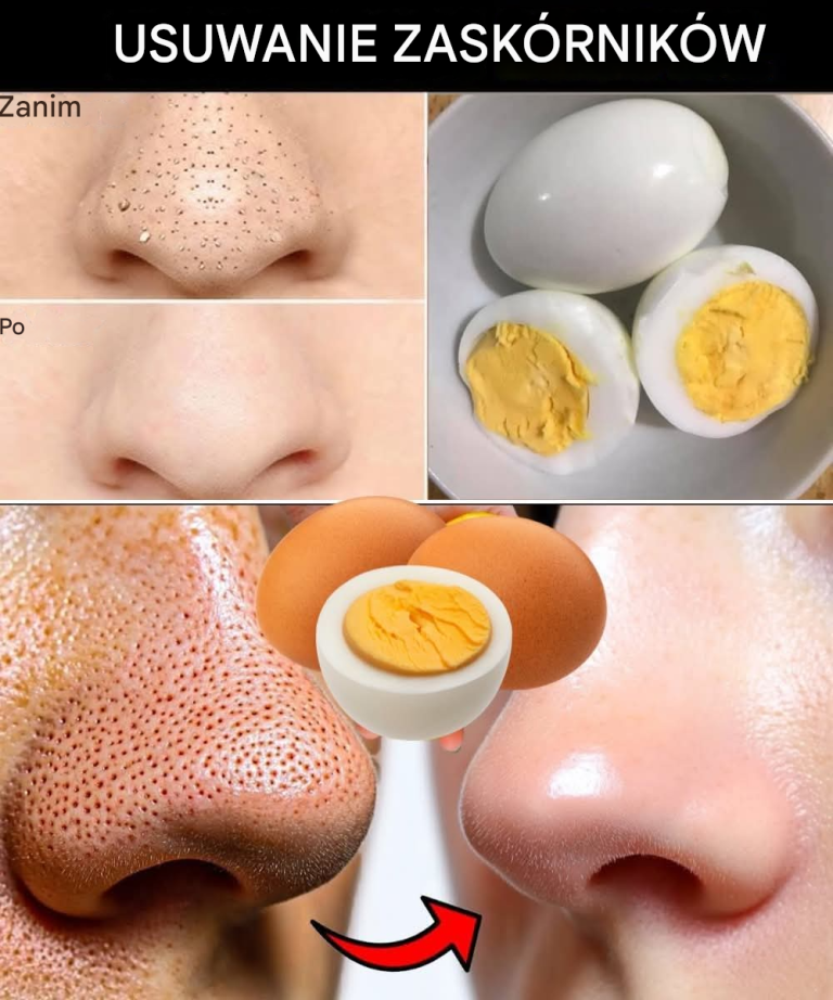 Pożegnaj się z Blackheads z jednym jajkiem - oto jak!