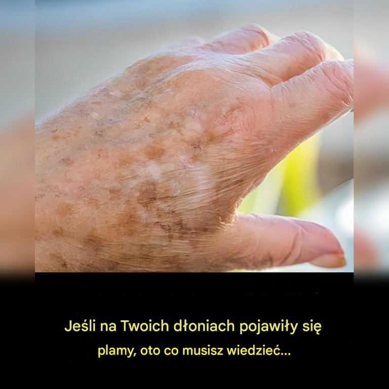 Czy wiesz, że jeśli plamy pojawią się na twoich rękach, to wyraźny znak, że...