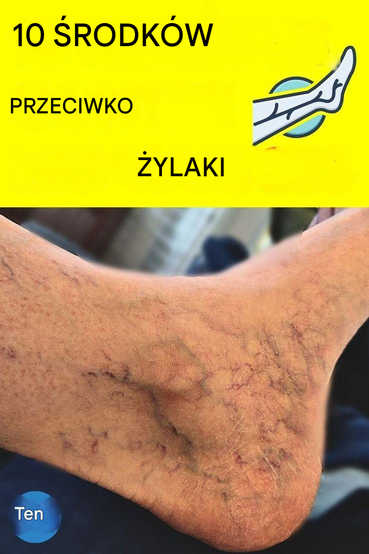 10 Miracle Remedies To Get Rid Of Varicose Veins Naturally. full recipes comment 👇👇