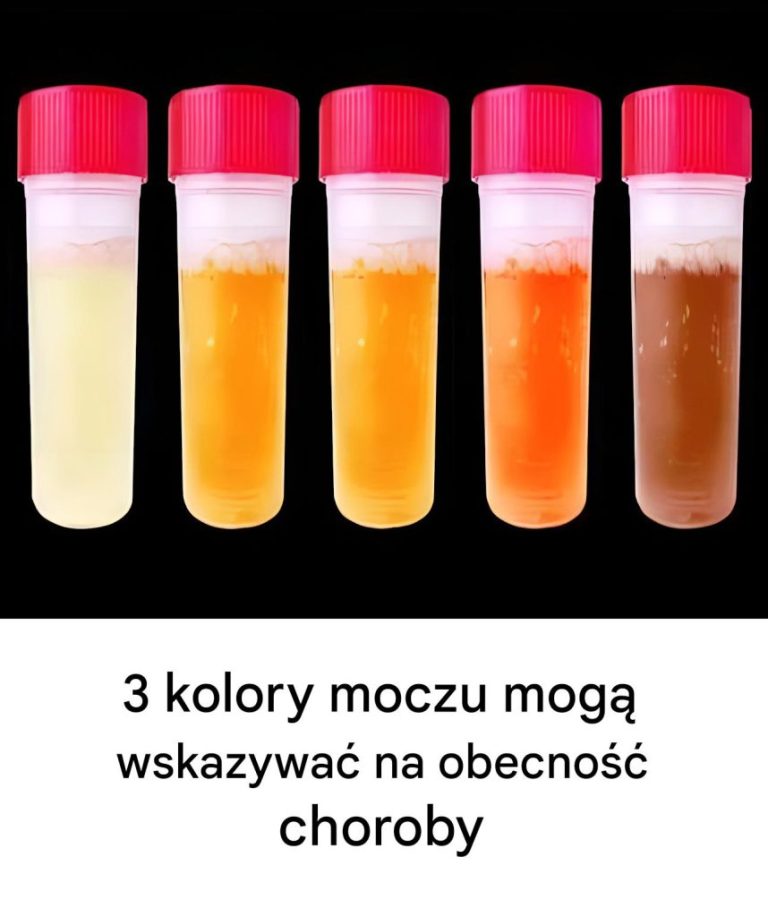 Jeśli Twój mocz przyjmie jeden z tych 3 kolorów, najlepiej skonsultować się z lekarzem